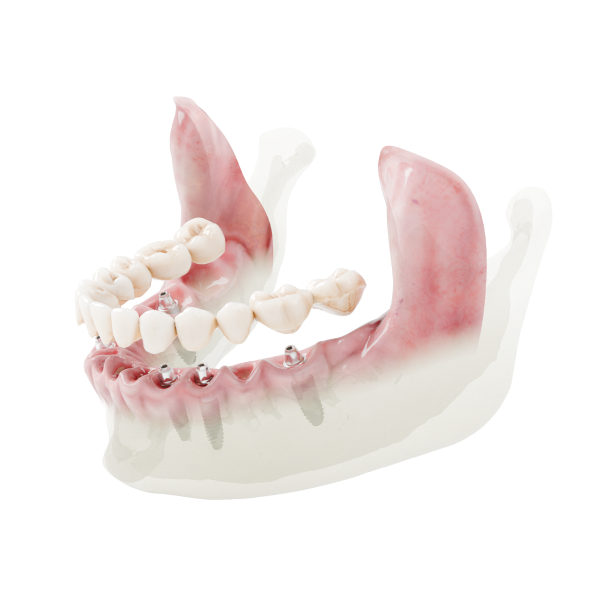 Dio NAVI Full Arch ürün grubu